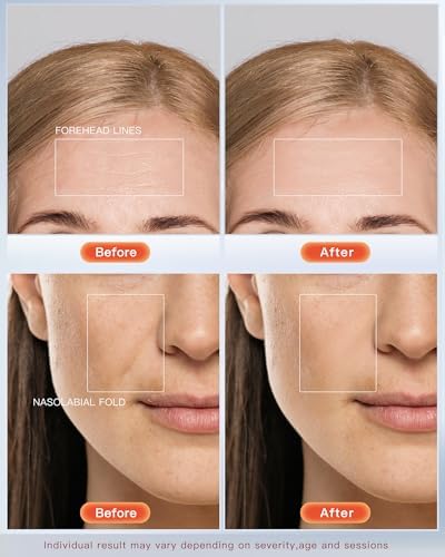 NEWKEY LED Red Face Mask Light Therapy for Skin Glowing, 630nm Red Light Therapy for Face Wrinkle, 465nm Blue Light Therapy Mask for Acne, 150LEDs, 10 Min Auto Shut Off, Reliable Wired Design - Dealqueen